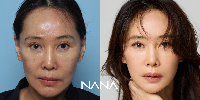 リフティング 症例写真 — 症例写真