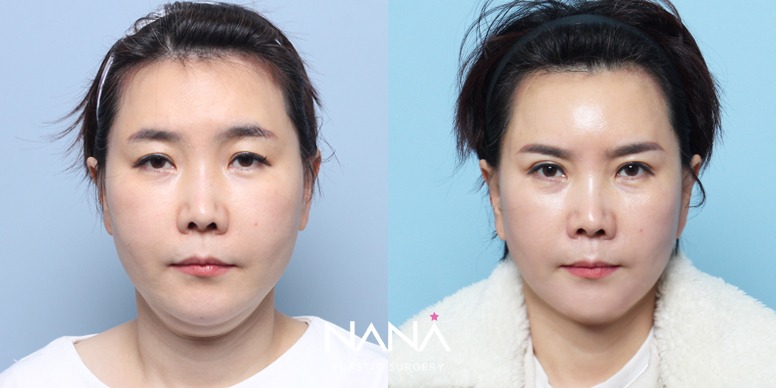 リフティング 症例写真 — 症例写真