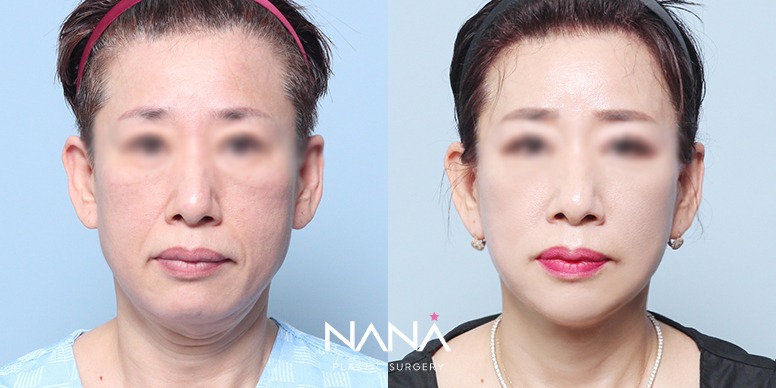 リフティング 症例写真 — 症例写真