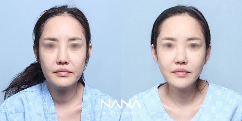 リフティング 症例写真 — 症例写真