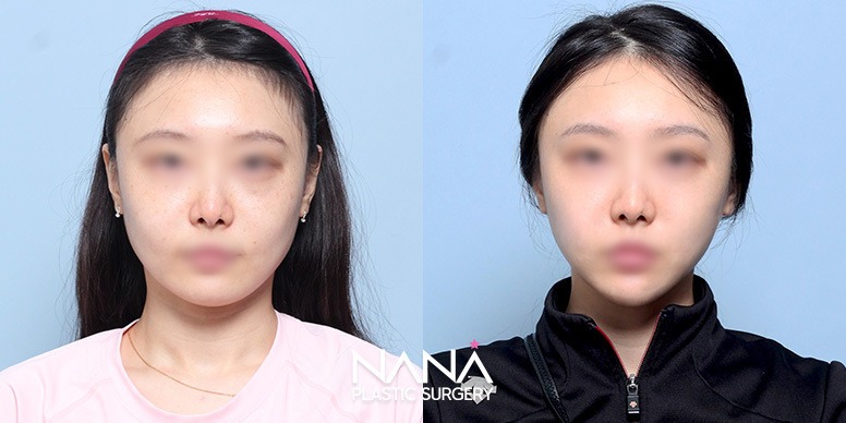 リフティング 症例写真 — 症例写真