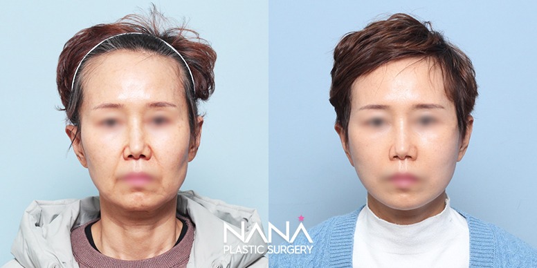 リフティング 症例写真 — 症例写真
