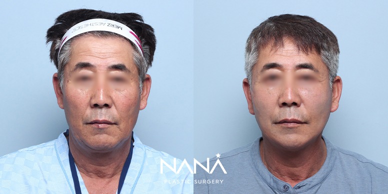 リフティング 症例写真 — 症例写真