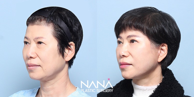 Before & After Before & After