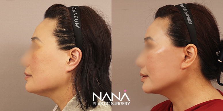 Before & After Before & After