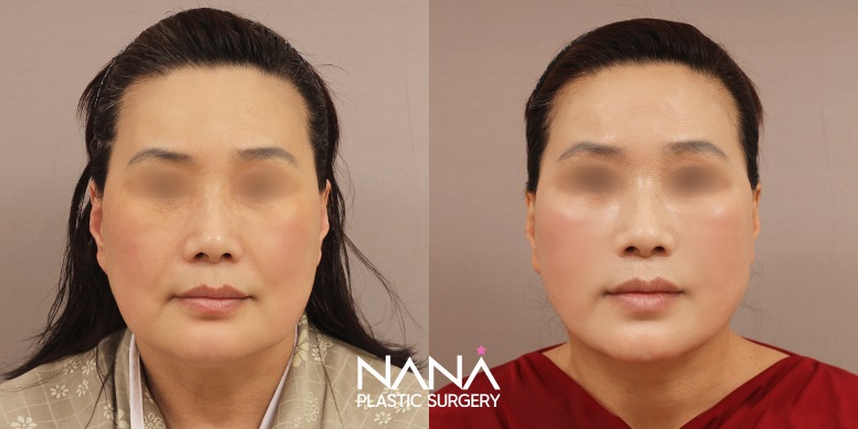 Lifting Before & After — Before & After