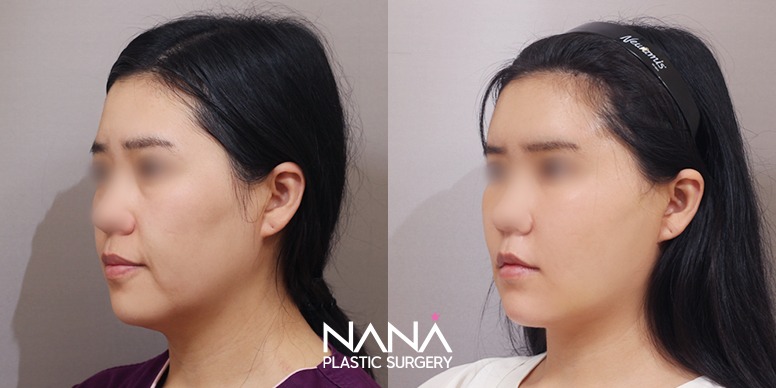 Before & After Before & After