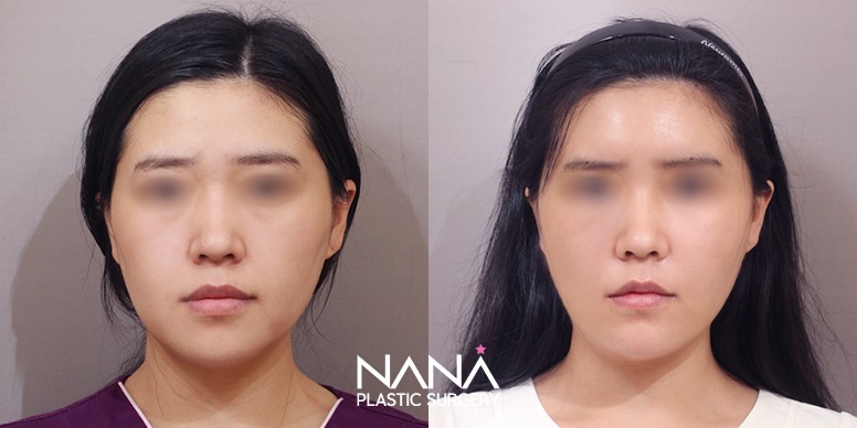 Before & After Before & After
