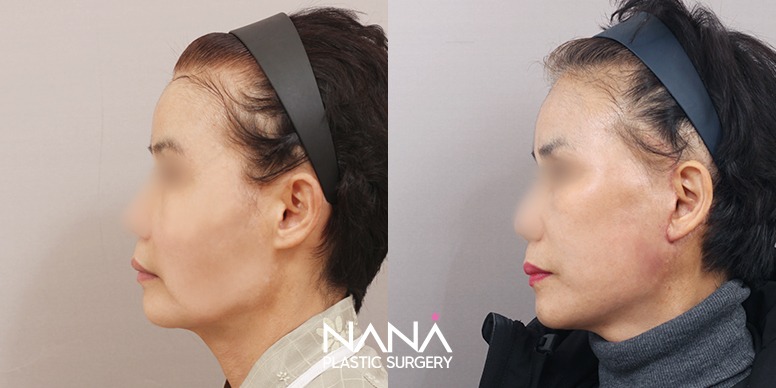 Before & After Before & After