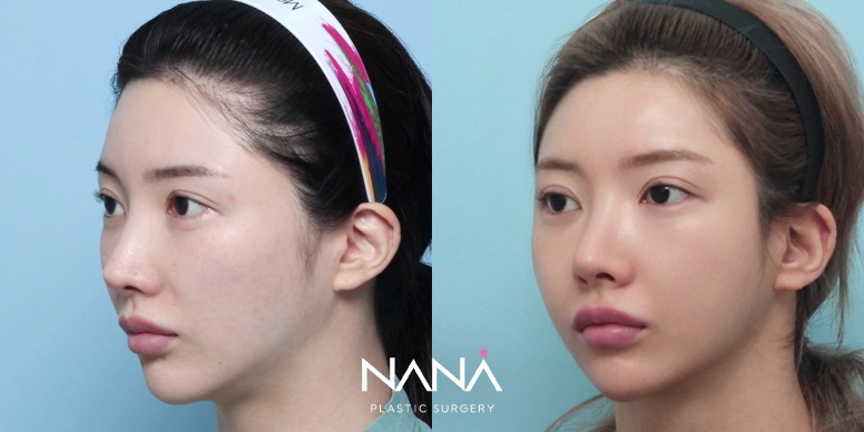 Before & After Before & After