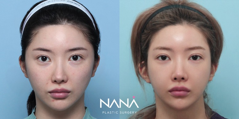 Lifting Before & After — Before & After