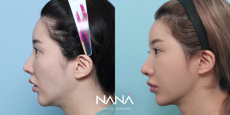 Before & After Before & After