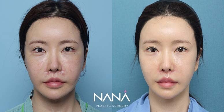 Lifting Before & After — Before & After