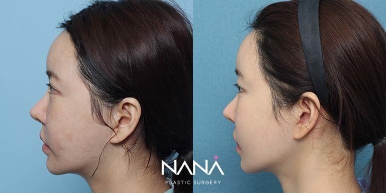 Before & After Before & After