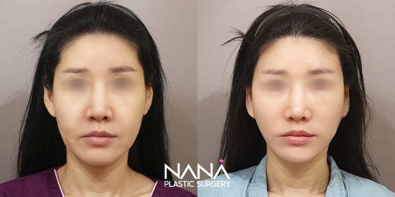 Lifting Before & After — Before & After