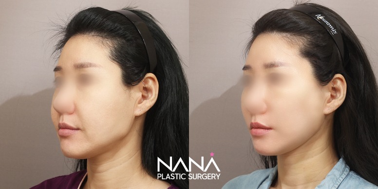 Before & After Before & After