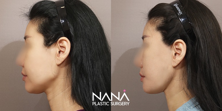 Before & After Before & After