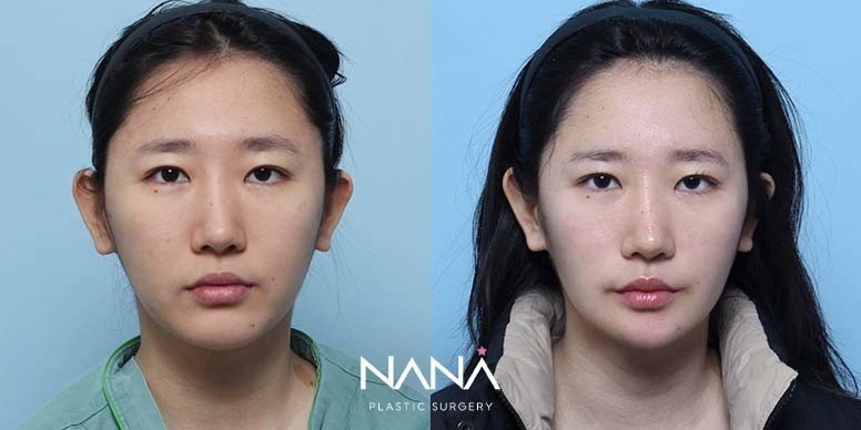 Lifting Before & After — Before & After