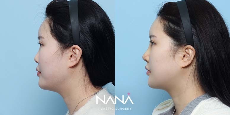 Before & After Before & After
