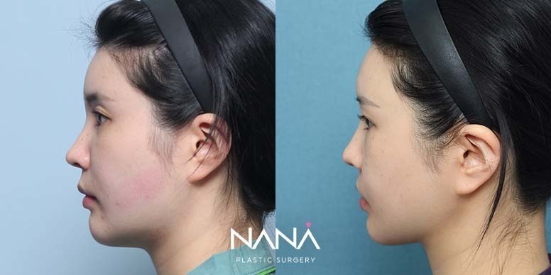 Before & After Before & After