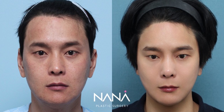 Lifting Before & After — Before & After