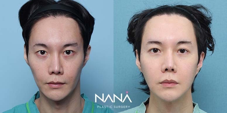 Lifting Before & After — Before & After