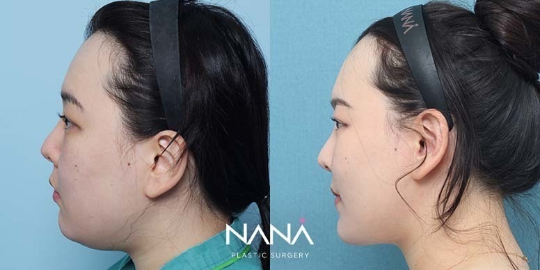 Before & After Before & After