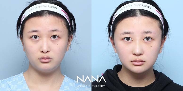 Lifting Before & After — Before & After