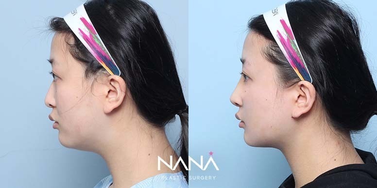 Before & After Before & After