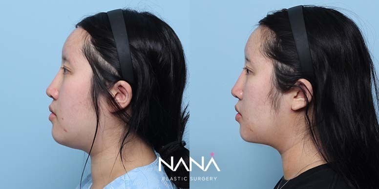 Before & After Before & After