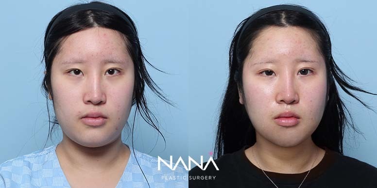 Lifting Before & After — Before & After
