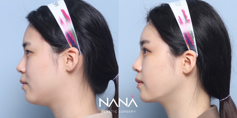 Before & After Before & After