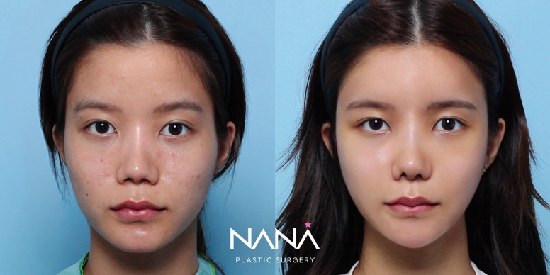 Lifting Before & After — Before & After