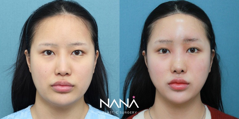 Lifting Before & After — Before & After