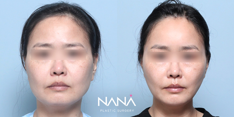 Lifting Before & After — Before & After