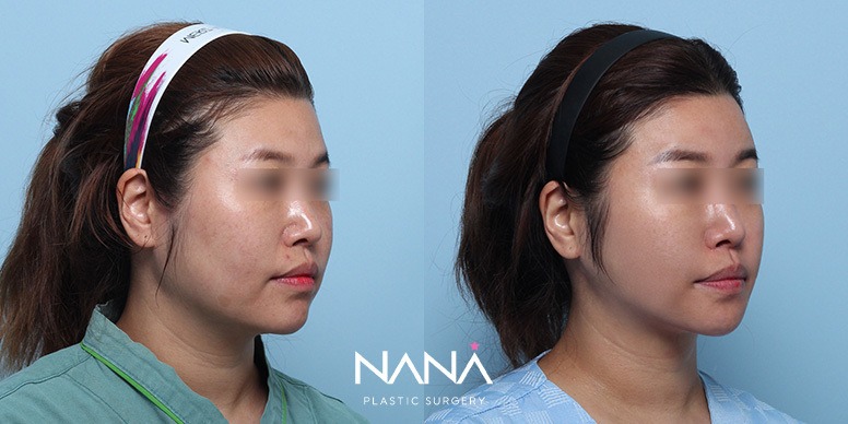 Before & After Before & After