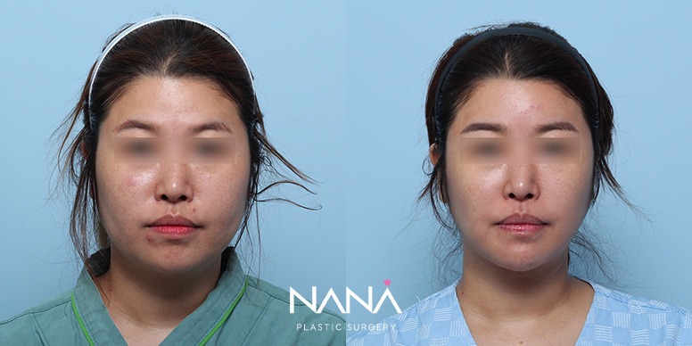 Lifting Before & After — Before & After