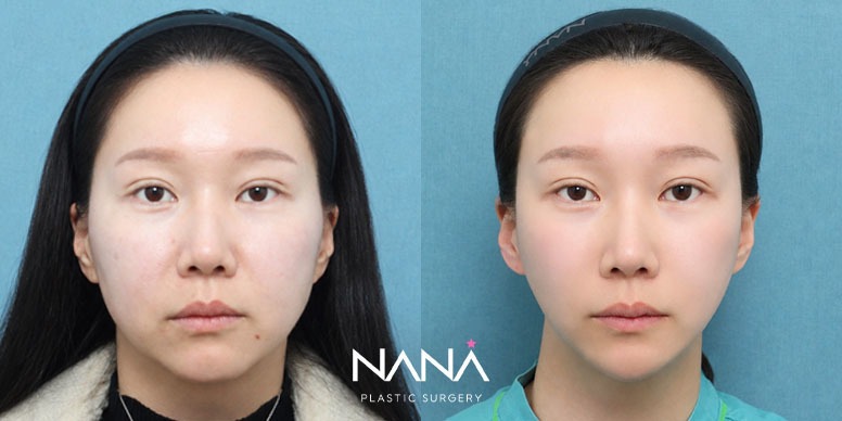 Lifting Before & After — Before & After