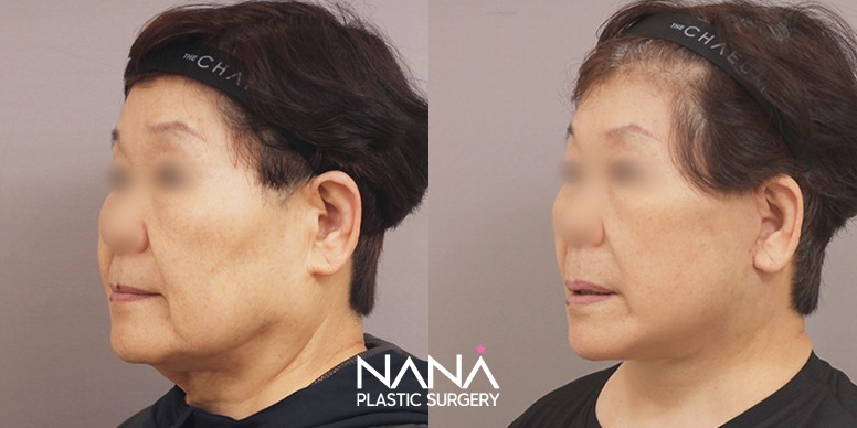 Before & After Before & After
