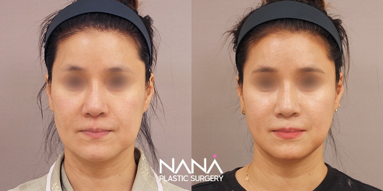 Lifting Before & After — Before & After