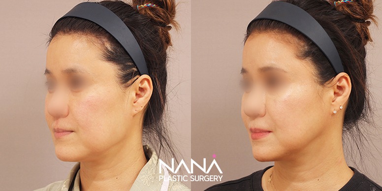 Before & After Before & After
