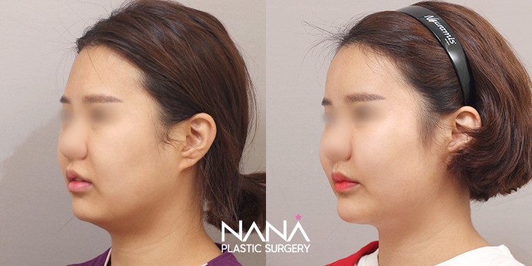 Before & After Before & After