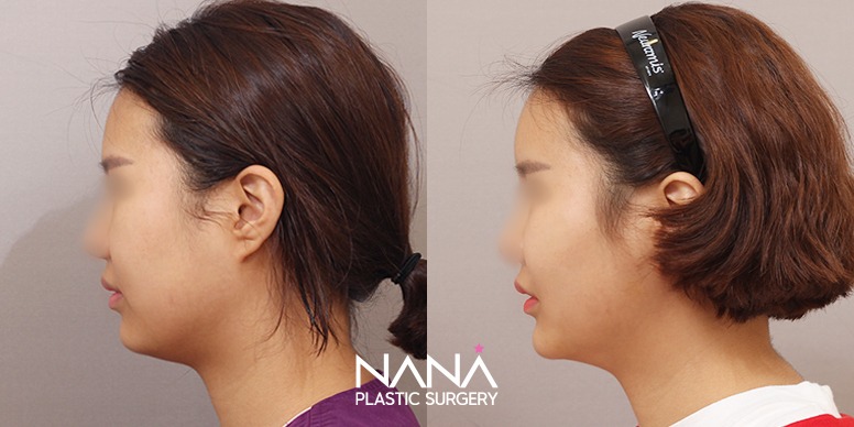 Before & After Before & After
