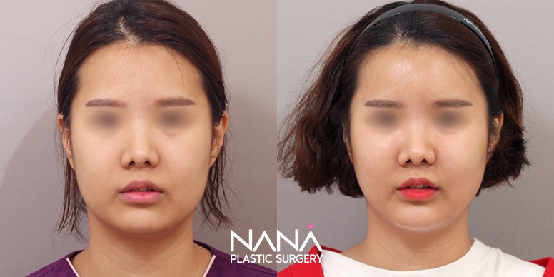 Lifting Before & After — Before & After