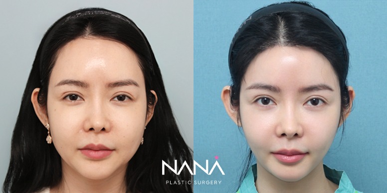 Lifting Before & After — Before & After