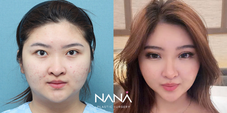 Lifting Before & After — Before & After