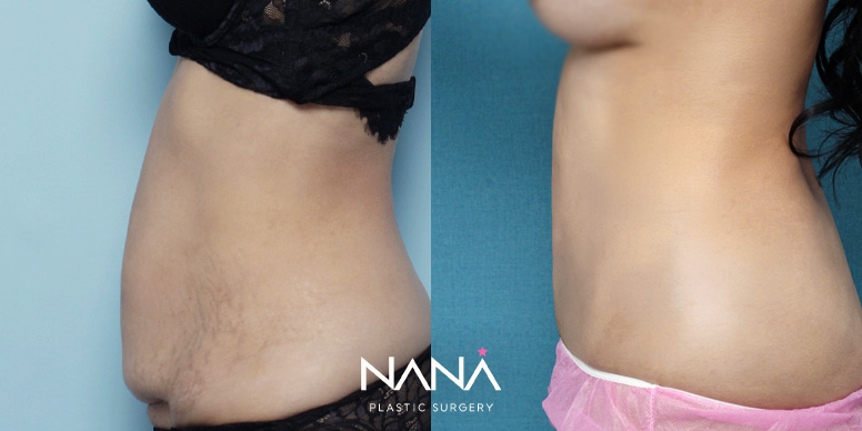 Before & After Before & After