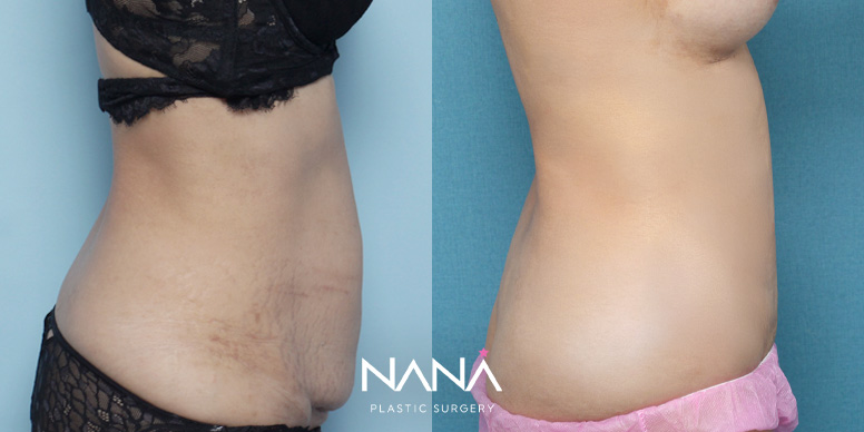 Before & After Before & After