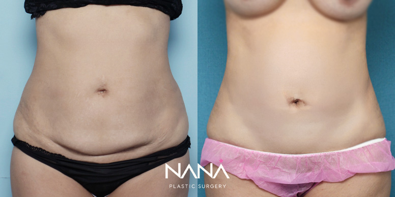 Liposuction Before & After — Before & After