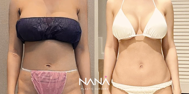 Liposuction Before & After — Before & After
